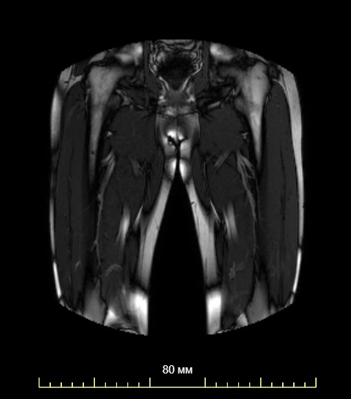 МРТ мягких тканей бедра, сделать в Москве, цена на МРТ мягких тканей ...